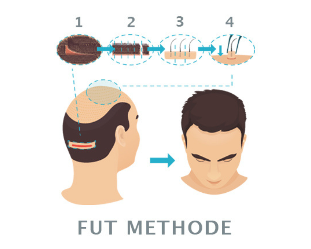 FUT Haartransplantation — Streifenentnahme am Hinterkopf