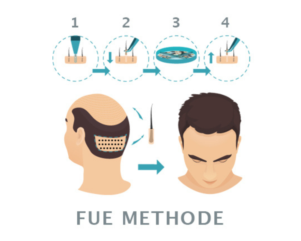 FUE Haartransplantation — Einzelentnahme der Haarfollikel mit Hohlnadel