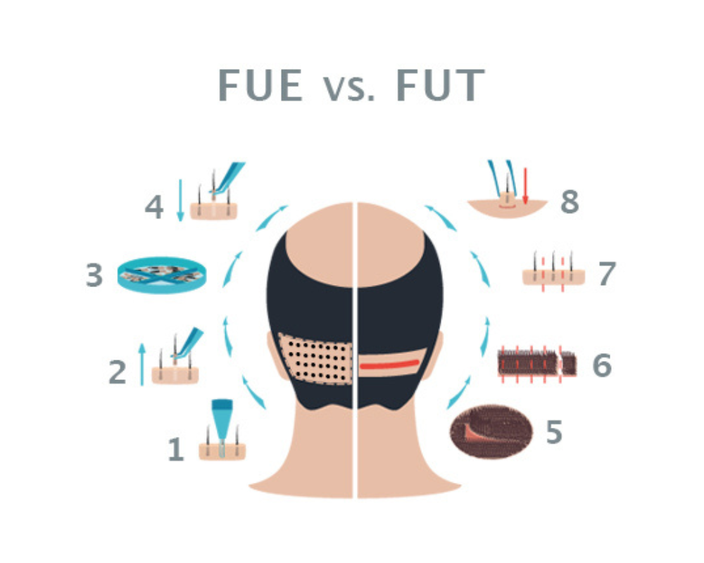 Vergleichsdiagramm der Haartransplantation: FUE mit einzelner Graft-Entnahme links, FUT Streifenverfahren mit linearer Narbe rechts
