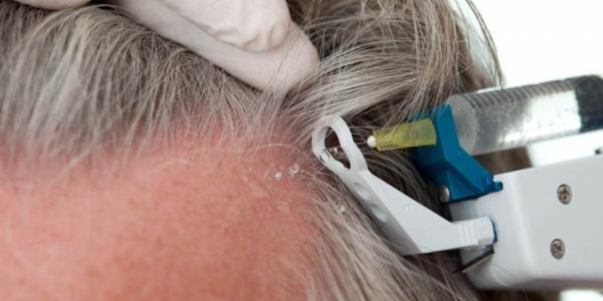 Munich-Hair-Transplantation-ROsenthal-Mesotherapie-Haare